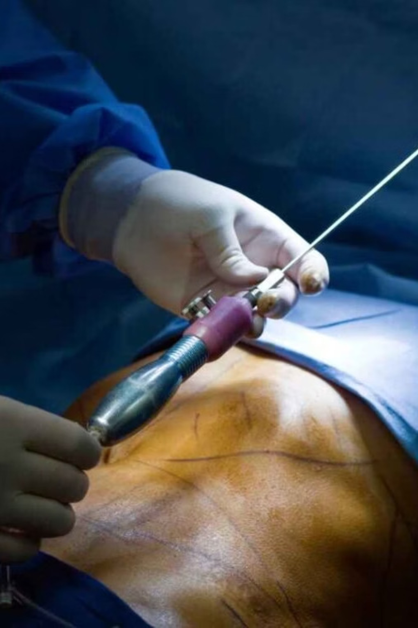 MasterClass Internacional Corporal Lipoescultura